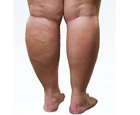 <h3>Edemas e Hinchazon</h3> Edemas e Hinchazon